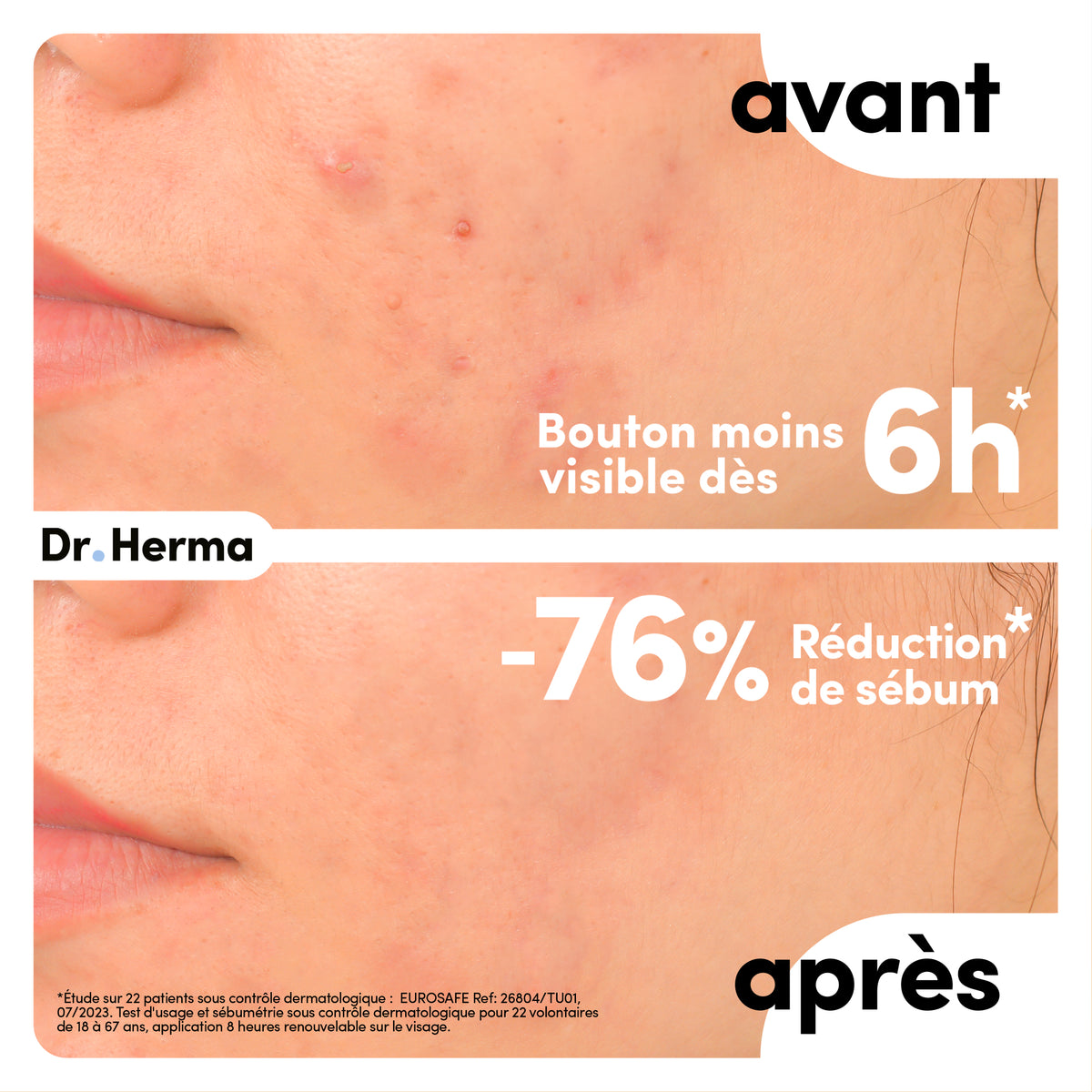 DR. HERMA Patchs Anti-Boutons Format Large – 10 patches